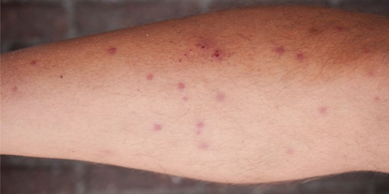 chigger bites on arm